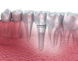 lower teeth and dental implant transparent render isolated on white