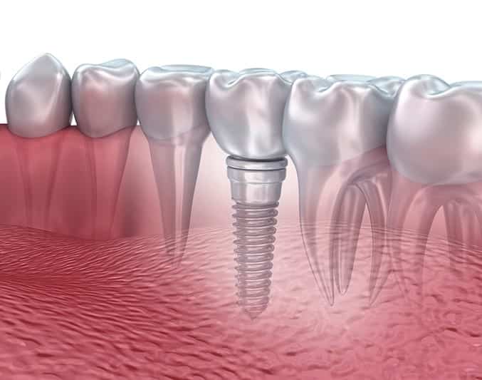 lower teeth and dental implant transparent render isolated on white