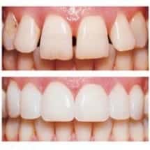 Porcelain_Veneers before and after