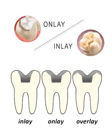 dental_inlays_onlays