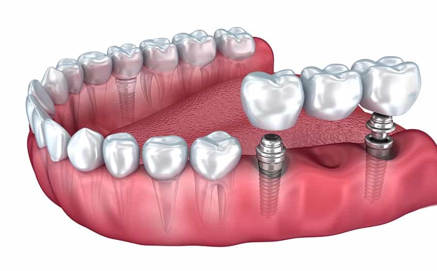 Lower teeth and dental implant transparent render isolated on white . 3D illustration