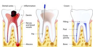 root canal picutre