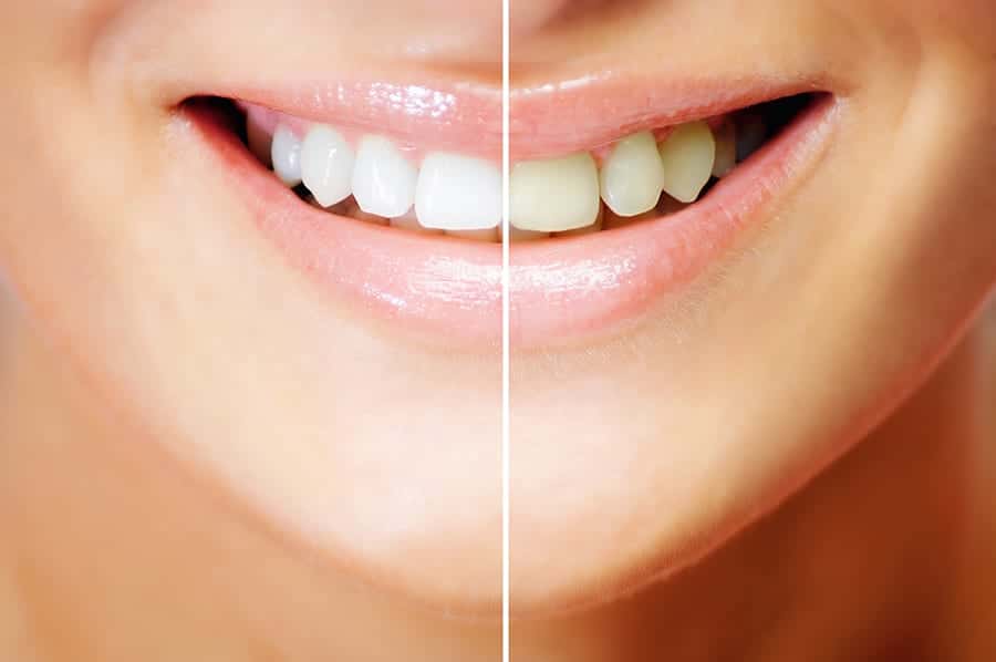 Dental Whitening services at Schmitt Dental in Tennessee