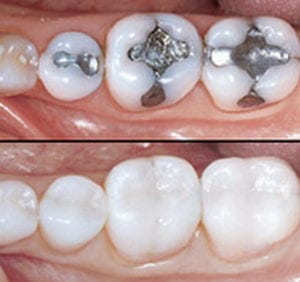tooth-colored-fillings
