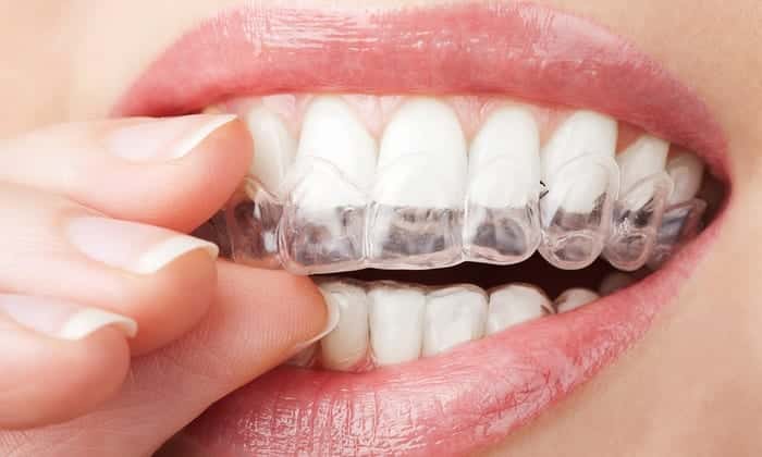 Invisalign Attachments: Why Are They Needed? - Luv My Smile