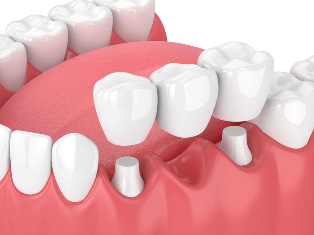 Dental Bridges in Clarksville TN | Brentwood TN | Schmitt Dental