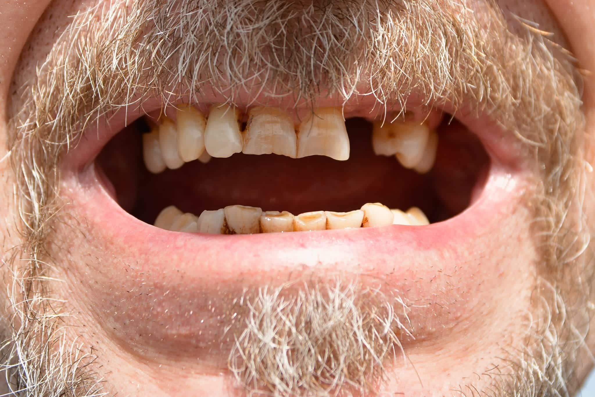 A man's mouth with diseased teeth.