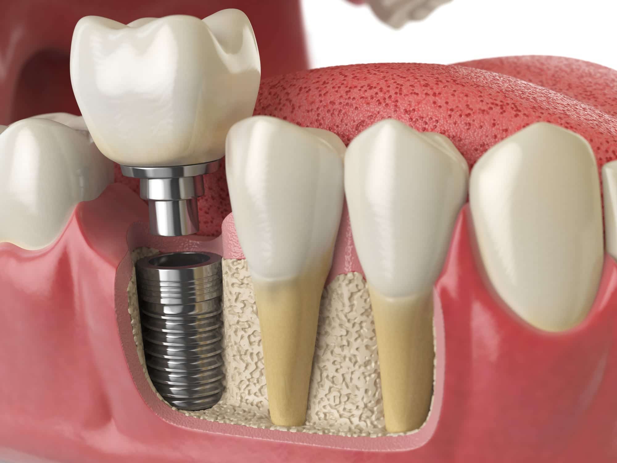 Anatomy of healthy teeth and tooth dental implant in human denturra.