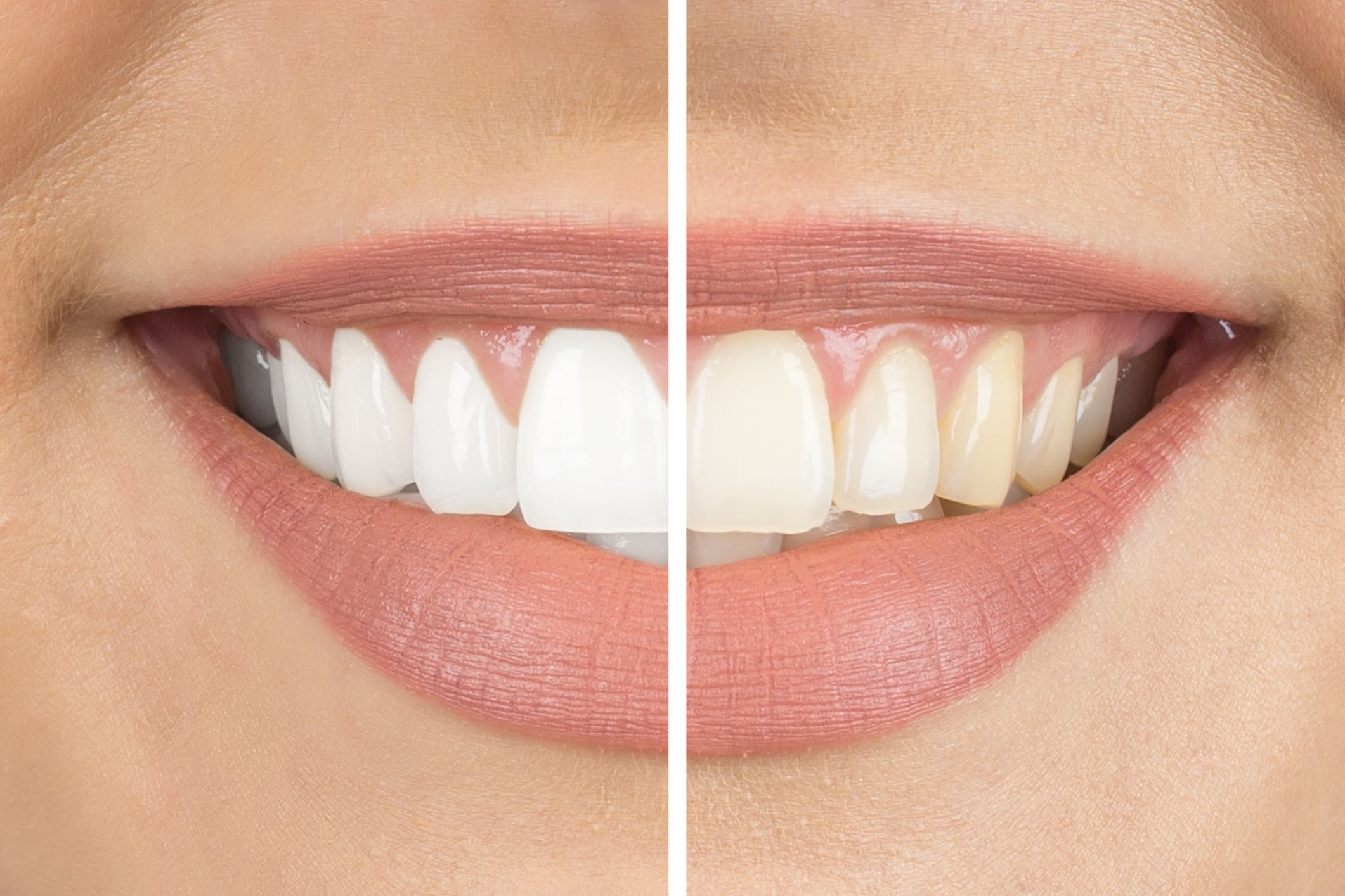 A before and after of a woman's mouth that underwent a teeth whitening procedure