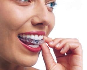 Woman wearing orthodontic silicone trainer