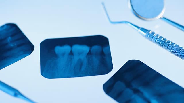 Dental xray results laying in the table