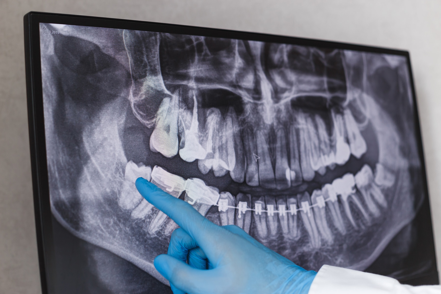 Tooth extraction consultation in Tennessee