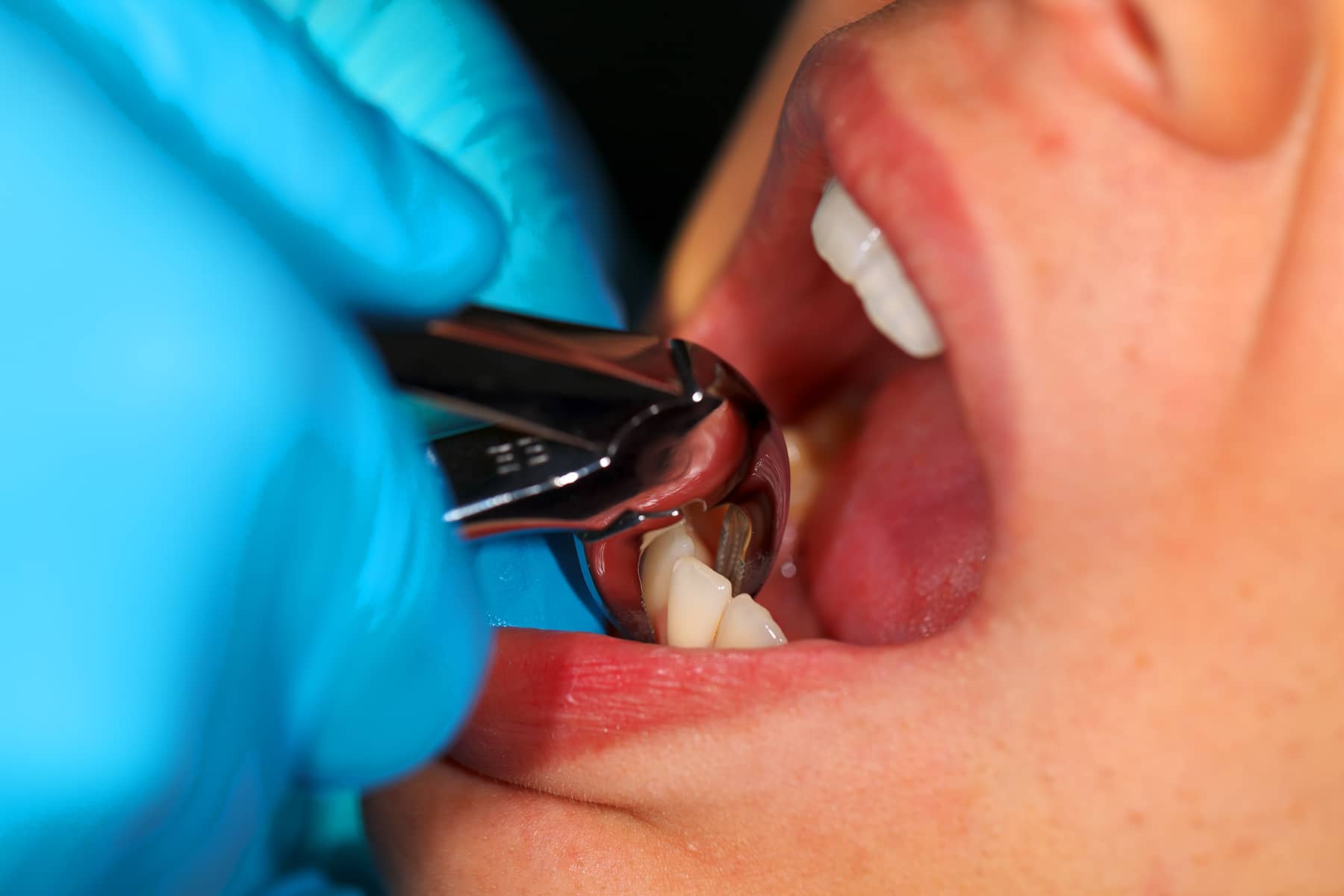 Dental Extractions in Tennessee