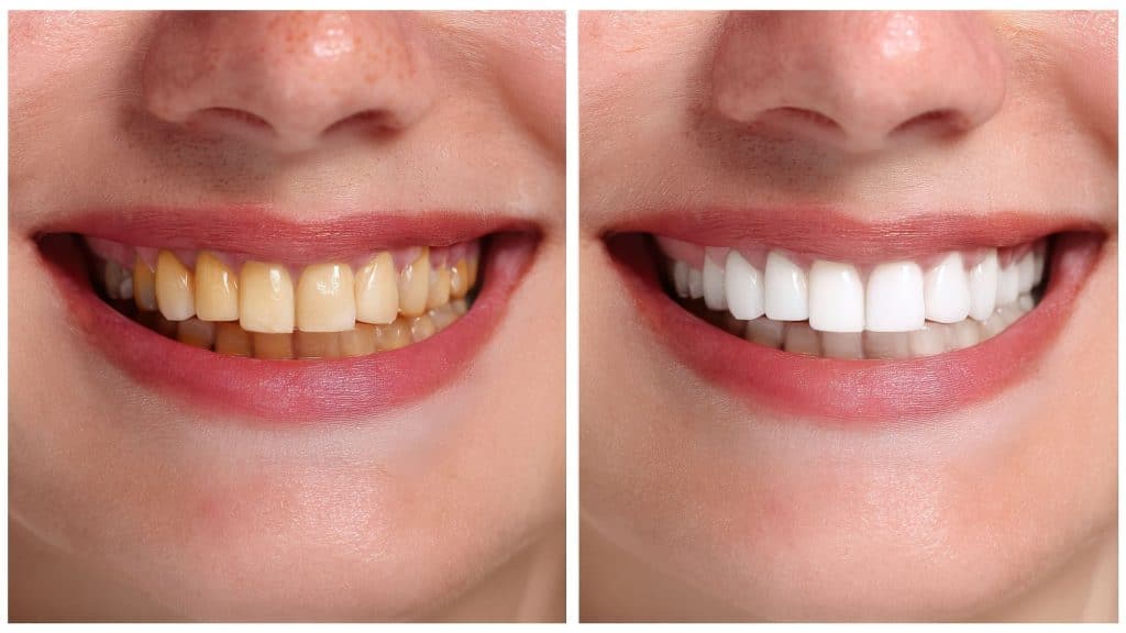 Why aren't my teeth white