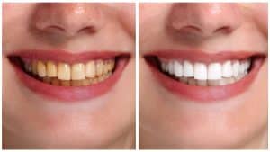 Why aren't my teeth white