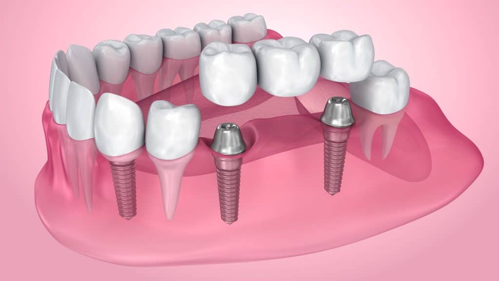 implants vs. bridges