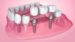 implants vs. bridges