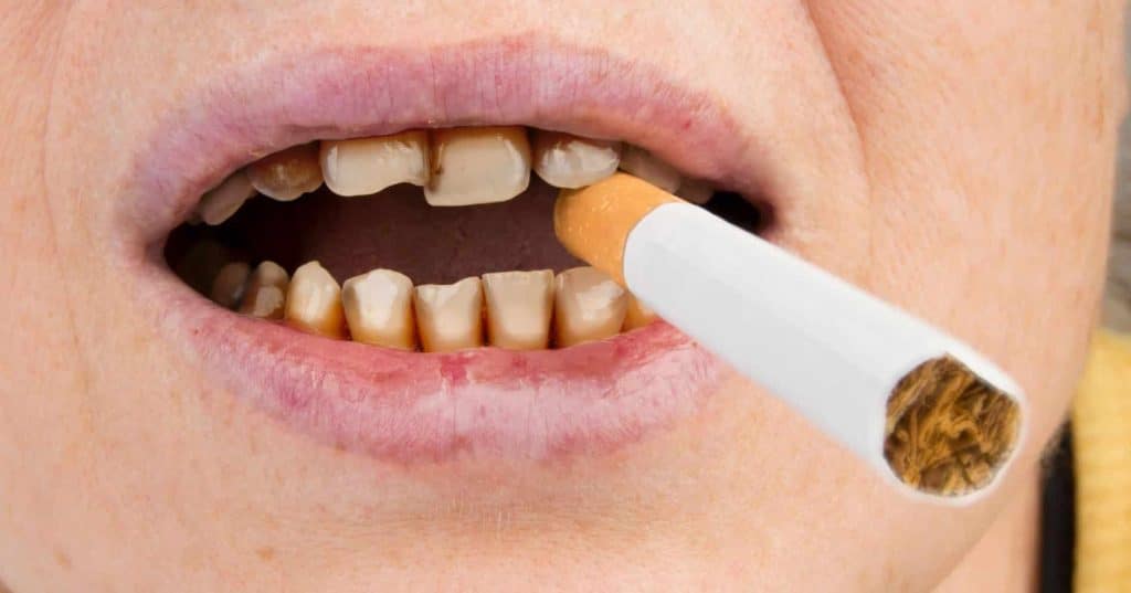 relationship between smoking and teeth